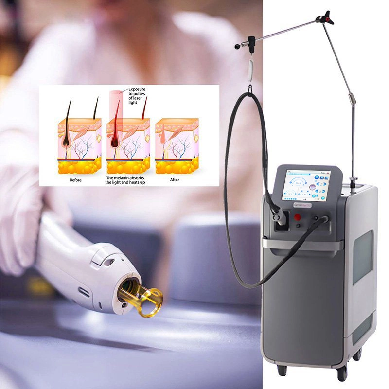 2021 New Hair Removal Machine Long Pulsed ND YAG Laser 1064nm Alexandrite 755nm Laser